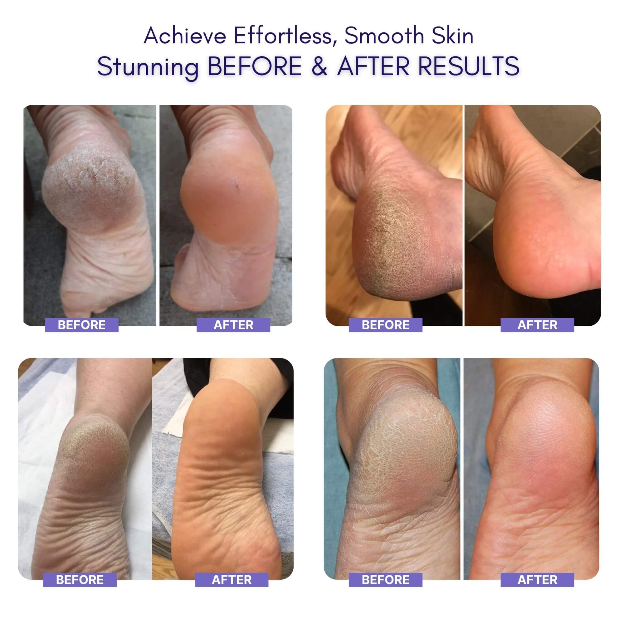 Electric Foot Callus Remover