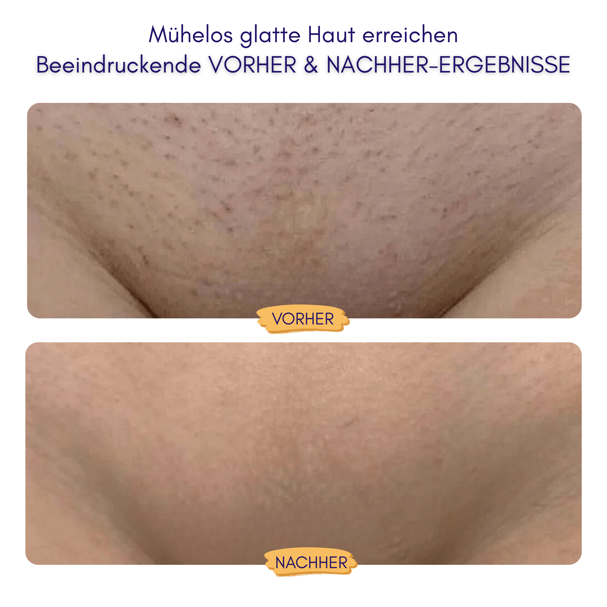 Nuvella™ Bikini Trimmer