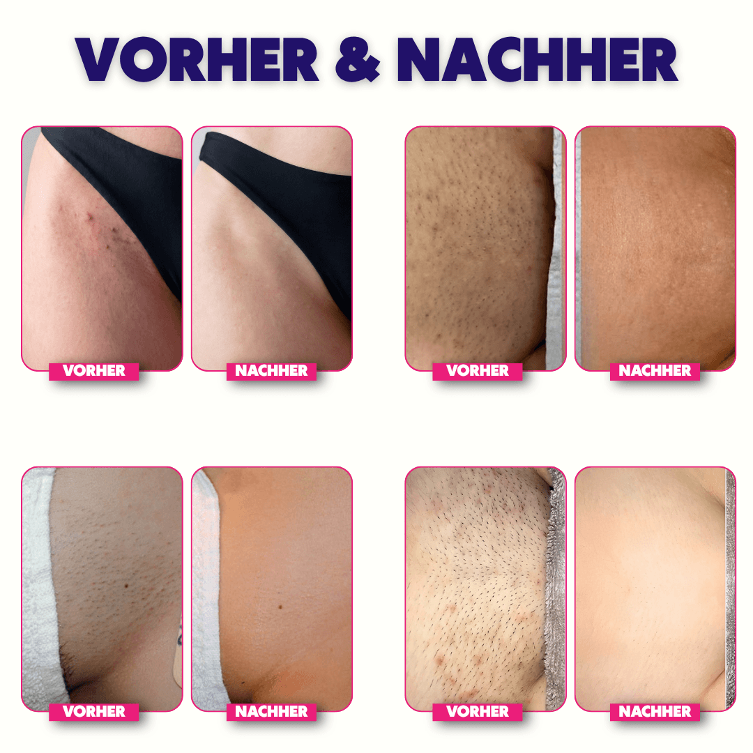 Nuvella™ Bikini Trimmer V1